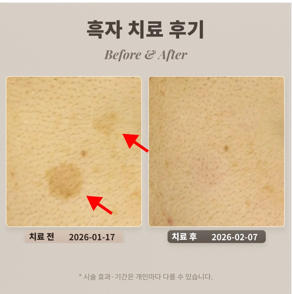 흑자 치료 후기