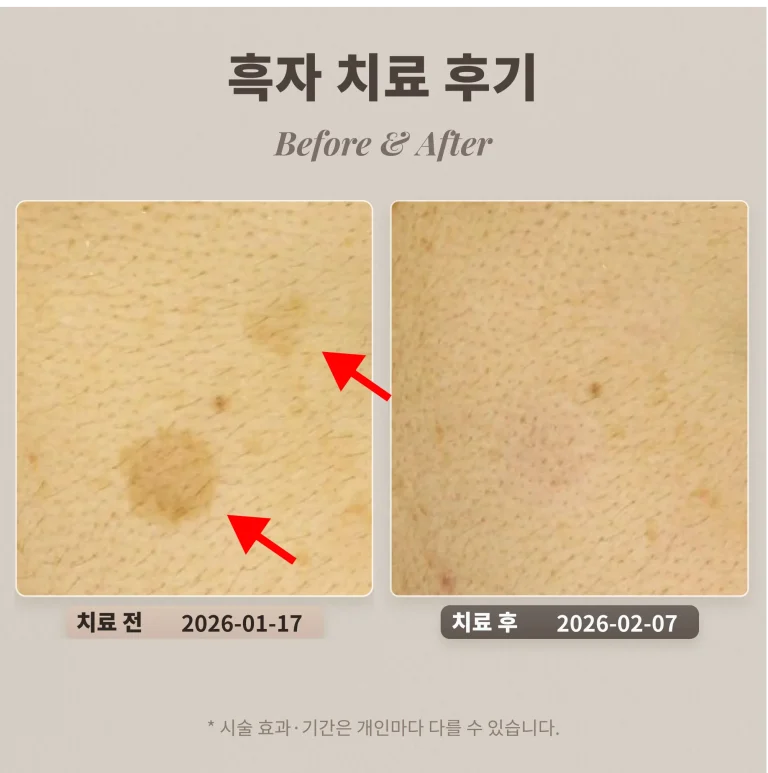 흑자 치료 후기