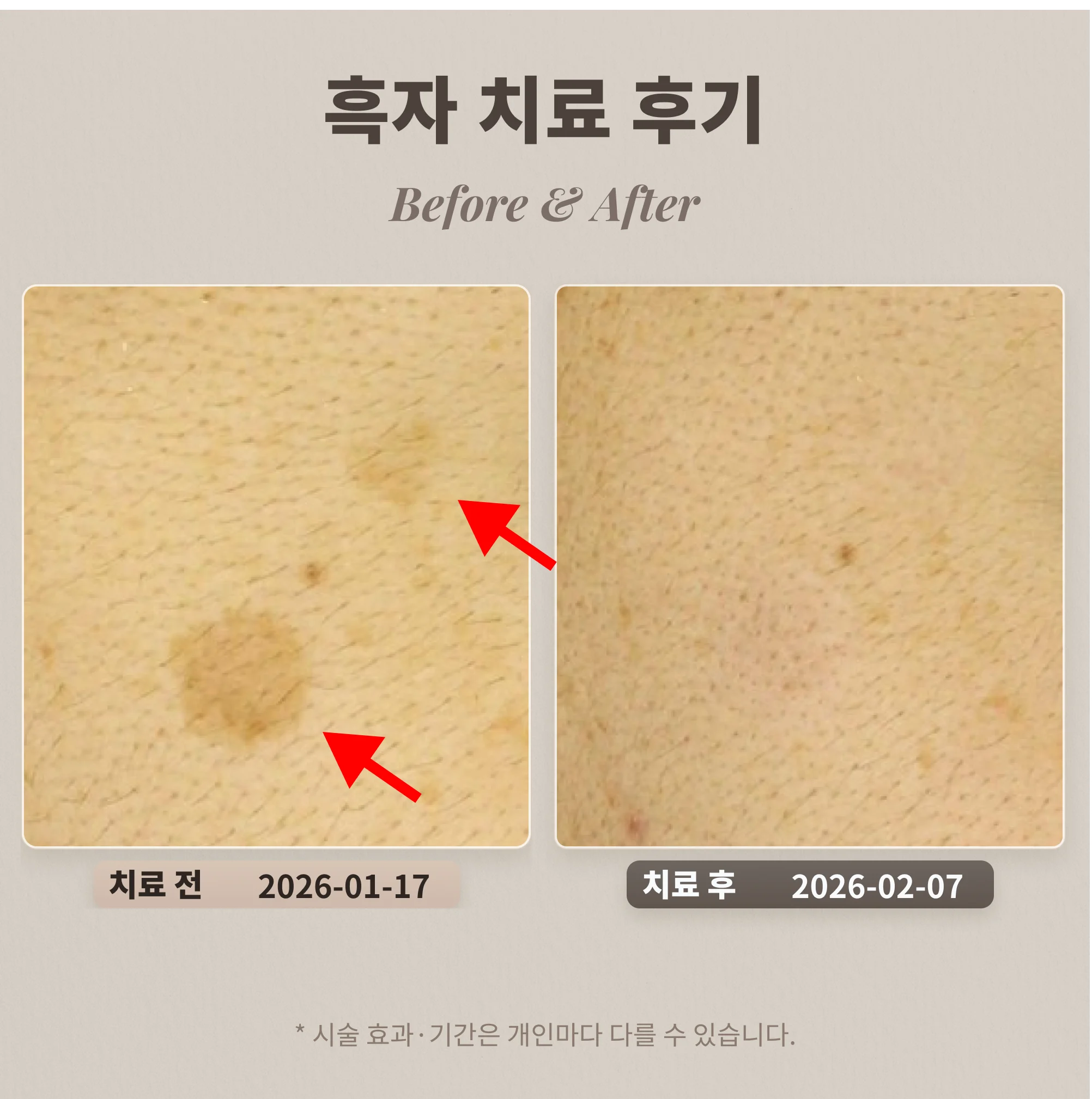 흑자 치료 후기