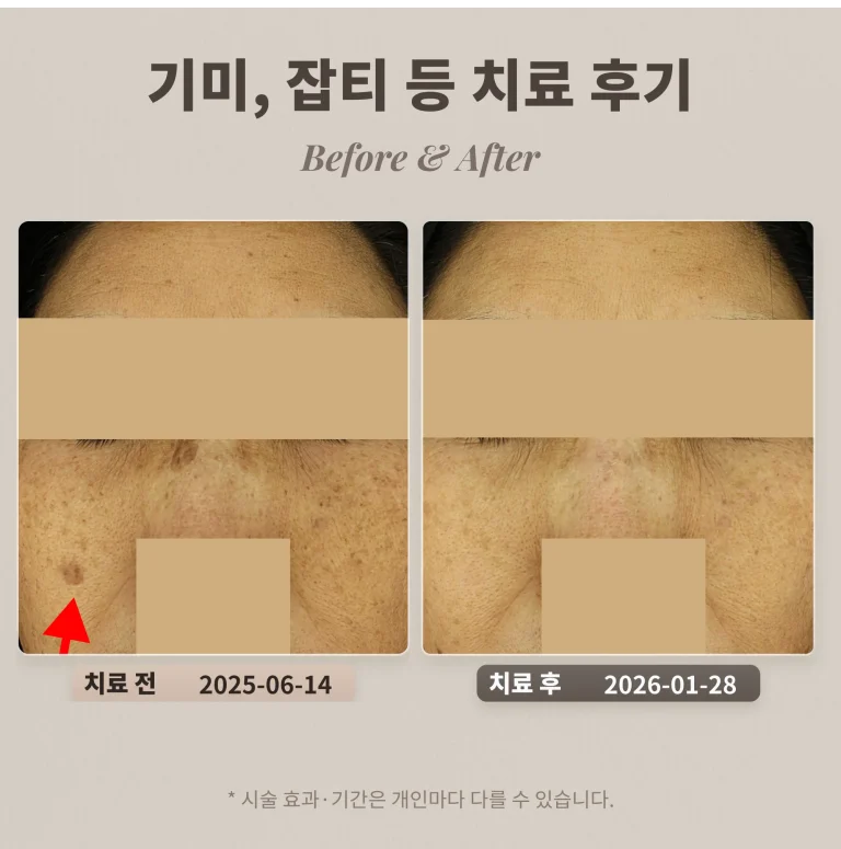 40대 여성 눈 아래 큰 갈색반점(색소침착 오인) 제거 후기_리팟레이저 후기