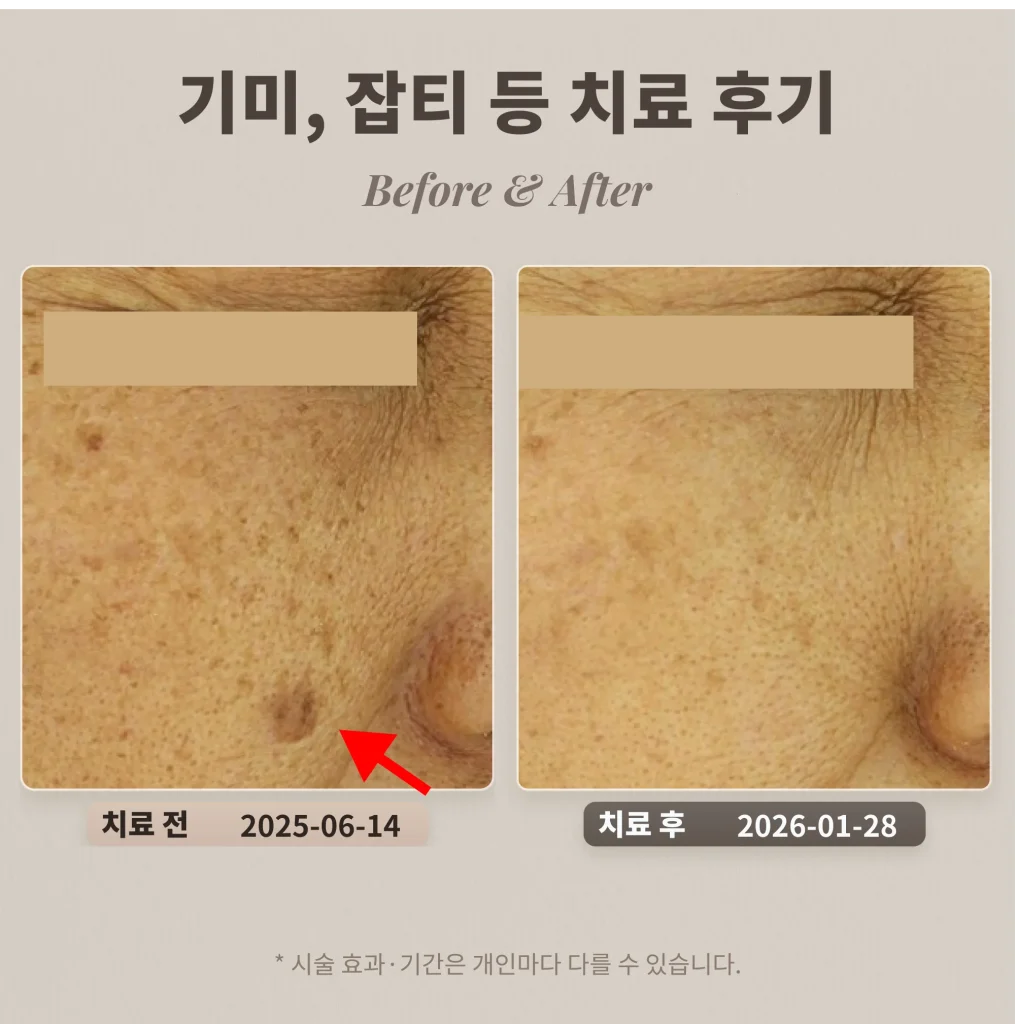 기미, 잡티 등 도자기 프로그램 치료 후기