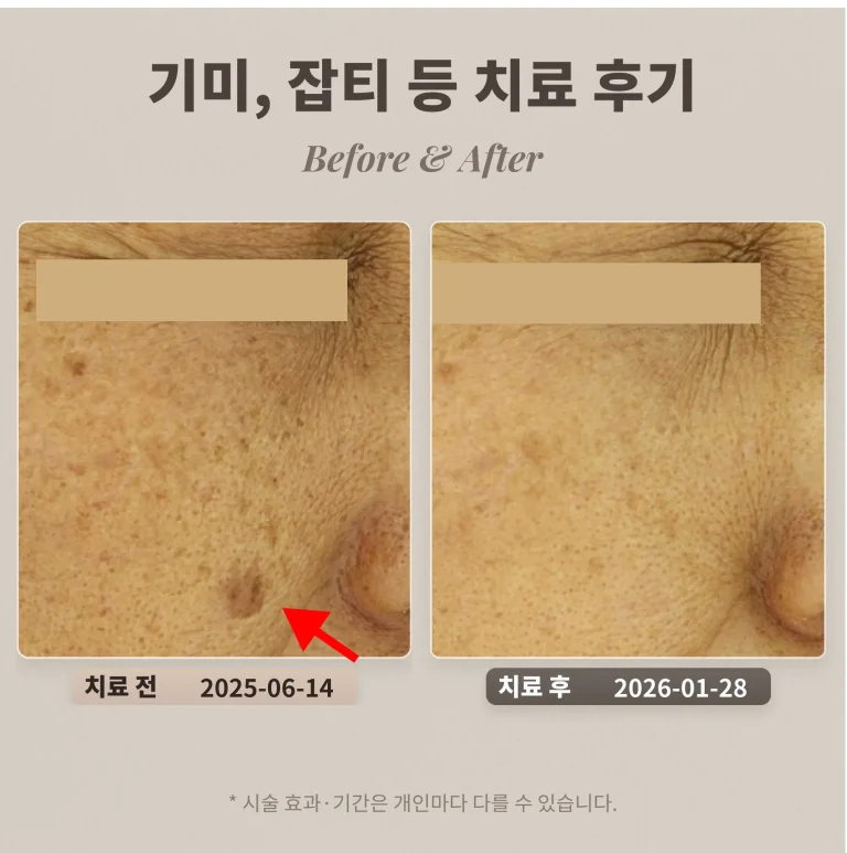 기미, 잡티 등 도자기 프로그램 치료 후기