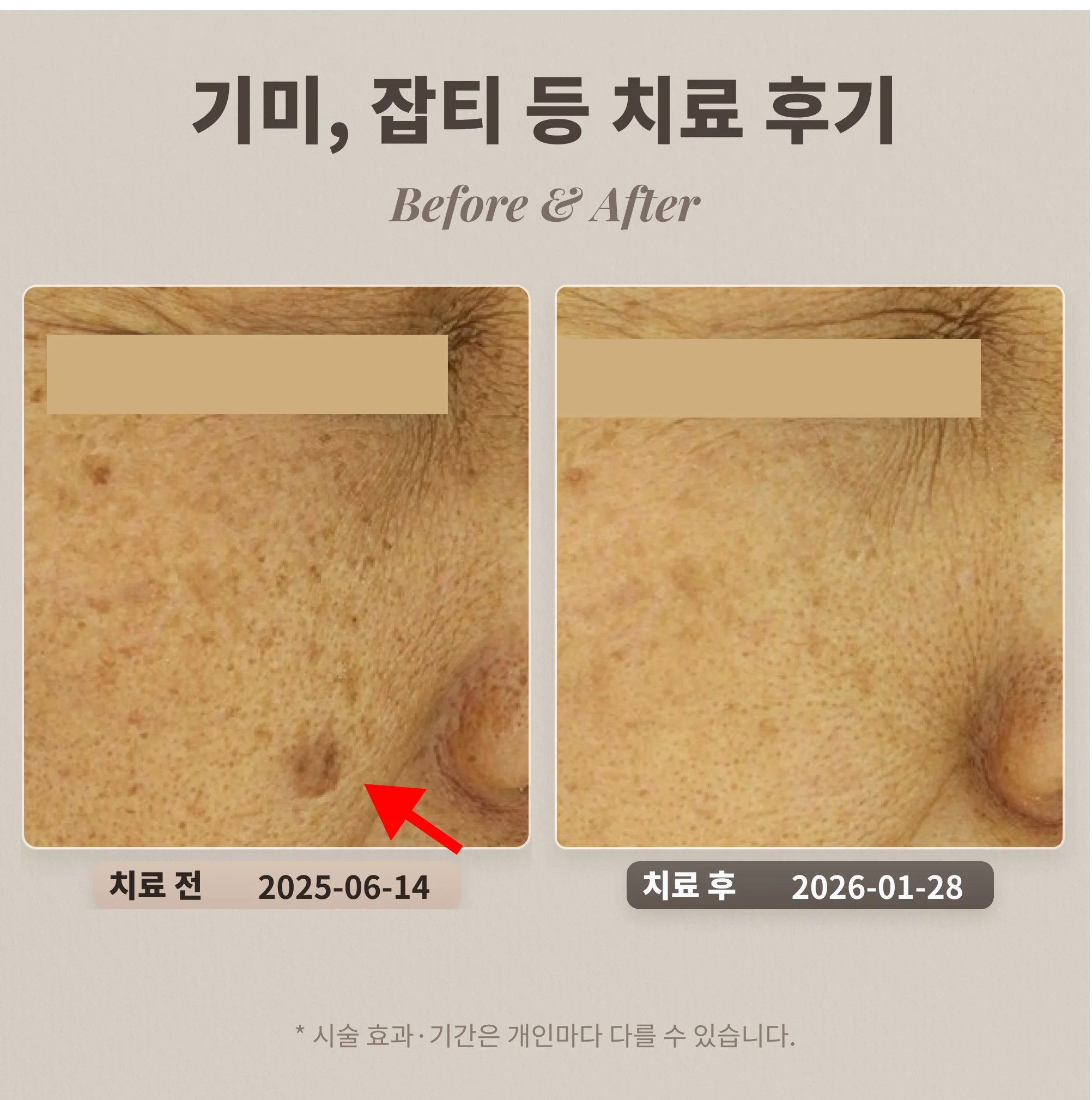 기미, 잡티 등 도자기 프로그램 치료 후기