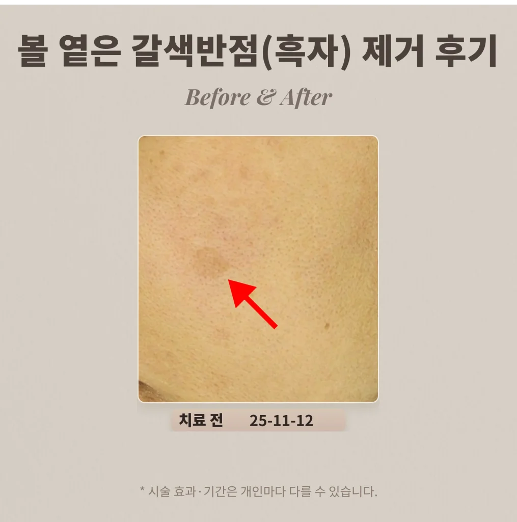 40대 여성 볼 부위 옅은 갈색반점(흑자) 제거 후기_강남 피부과 후기