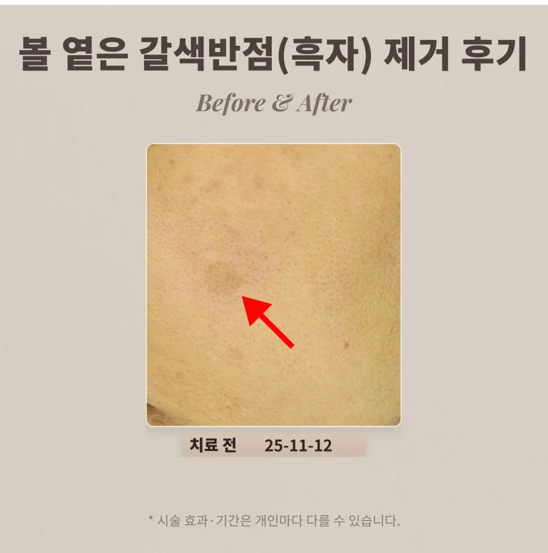 40대 여성 볼 부위 옅은 갈색반점(흑자) 제거 후기_강남 피부과 후기