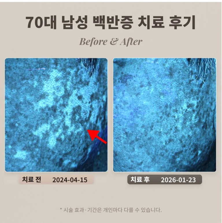 40대 흑자, 리팟레이저로 제거한 피부과 후기
