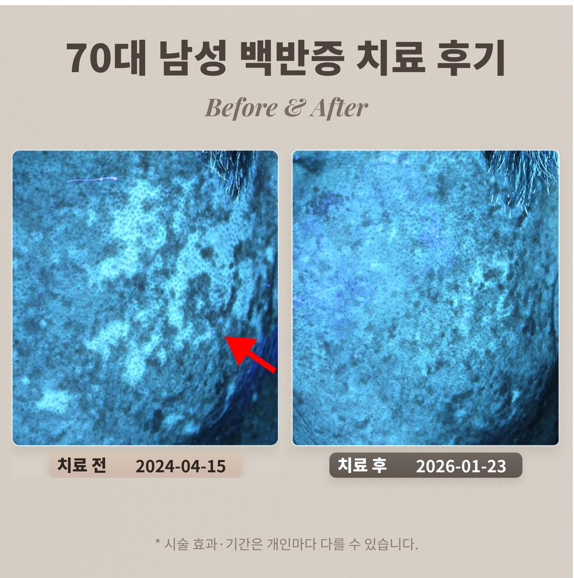 70대 남성 백반증 치료 후기