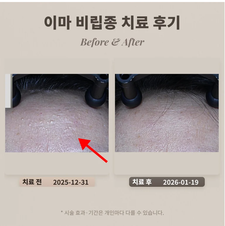 목주름 필러 후기