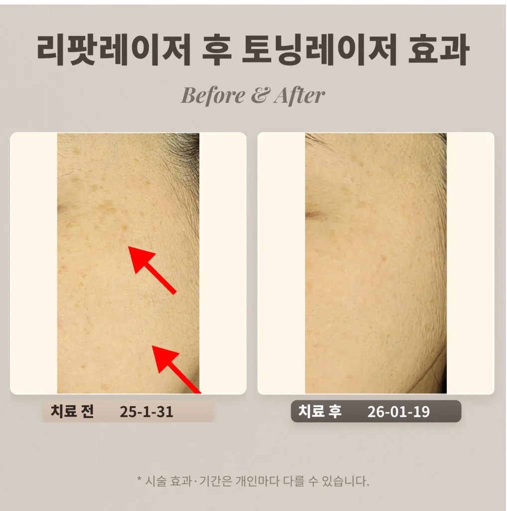 리팟레이저 후 토닝치료 어떤 효과가 있을까?
