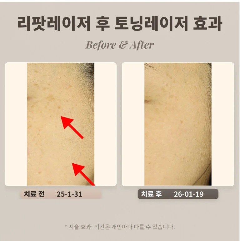 리팟레이저 후 토닝치료 어떤 효과가 있을까?