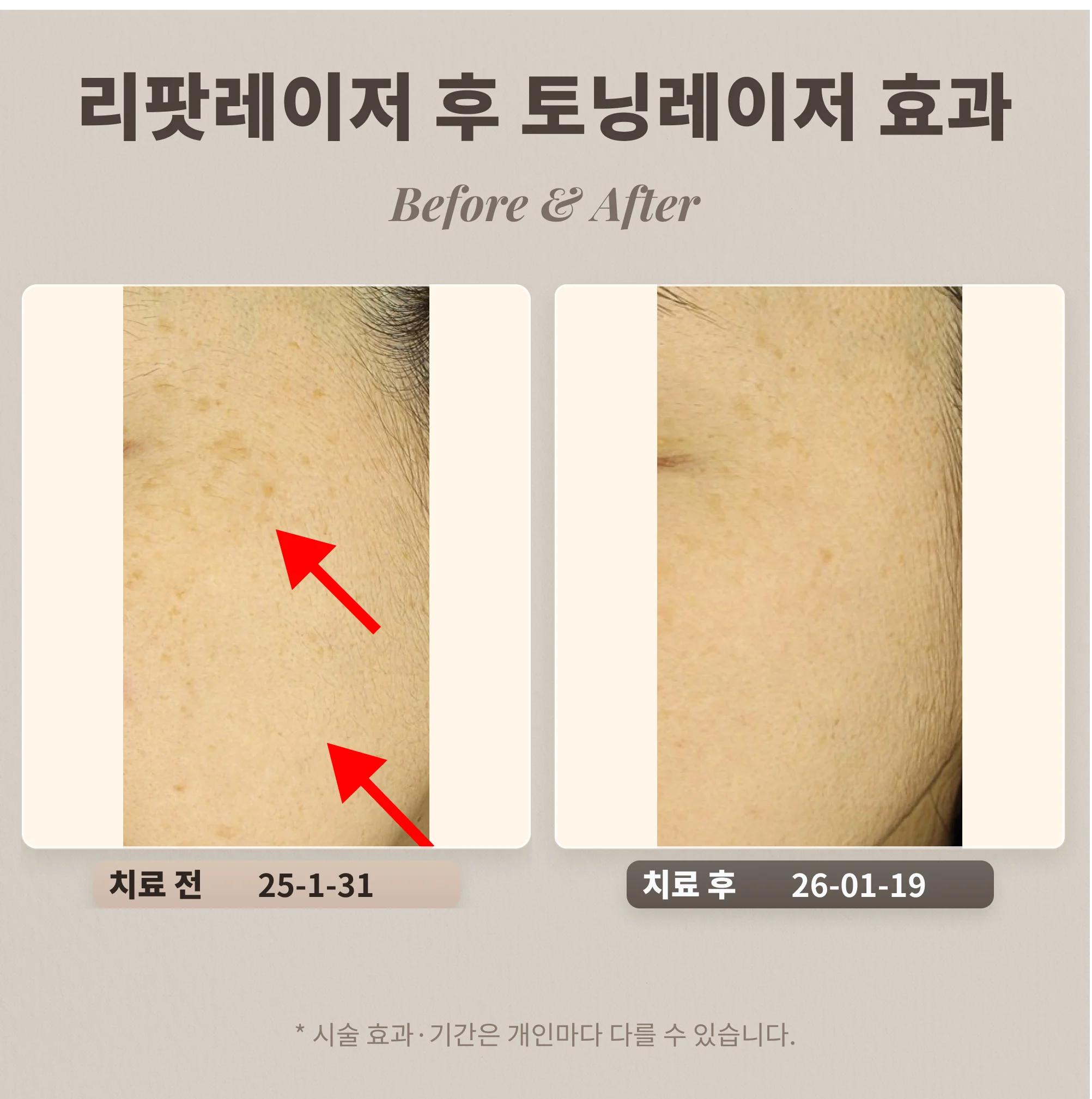 리팟레이저 후 토닝치료 어떤 효과가 있을까?