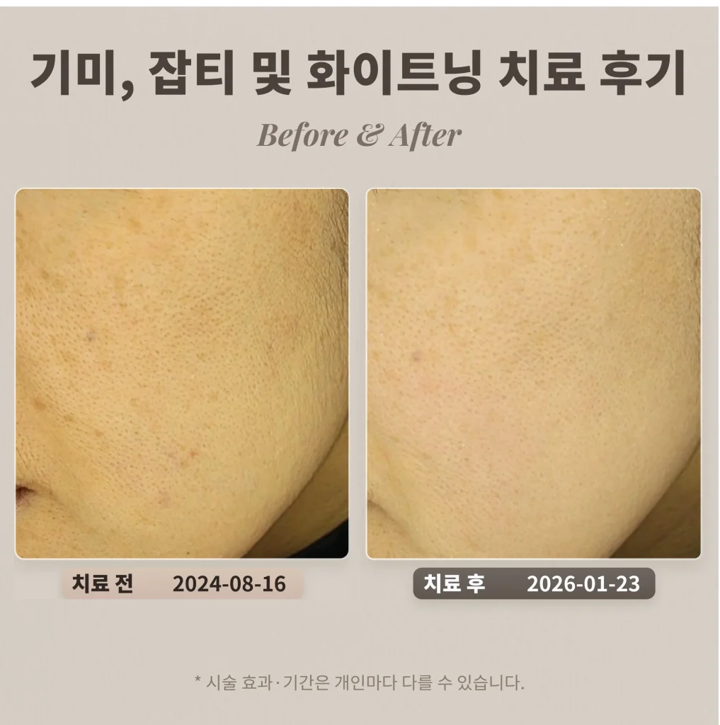 기미, 잡티 및 화이트닝(토닝) 치료 후기