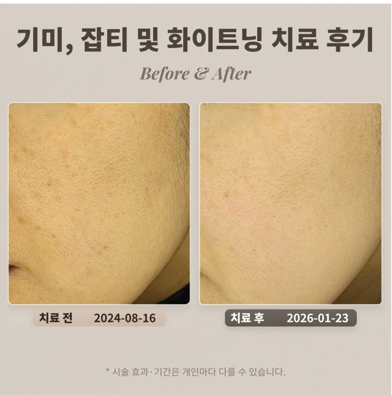 기미, 잡티 및 화이트닝(토닝) 치료 후기