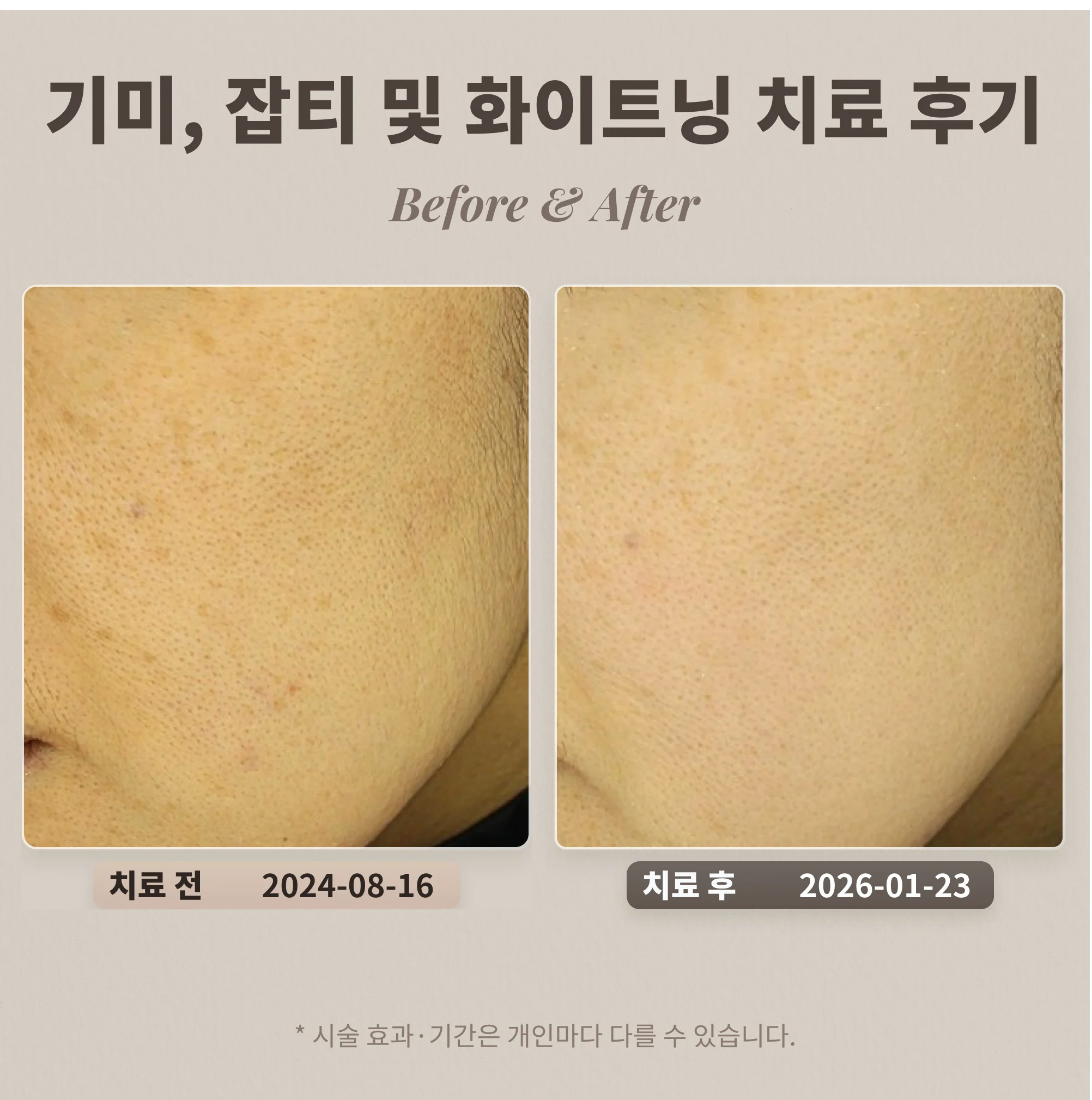 기미, 잡티 및 화이트닝(토닝) 치료 후기