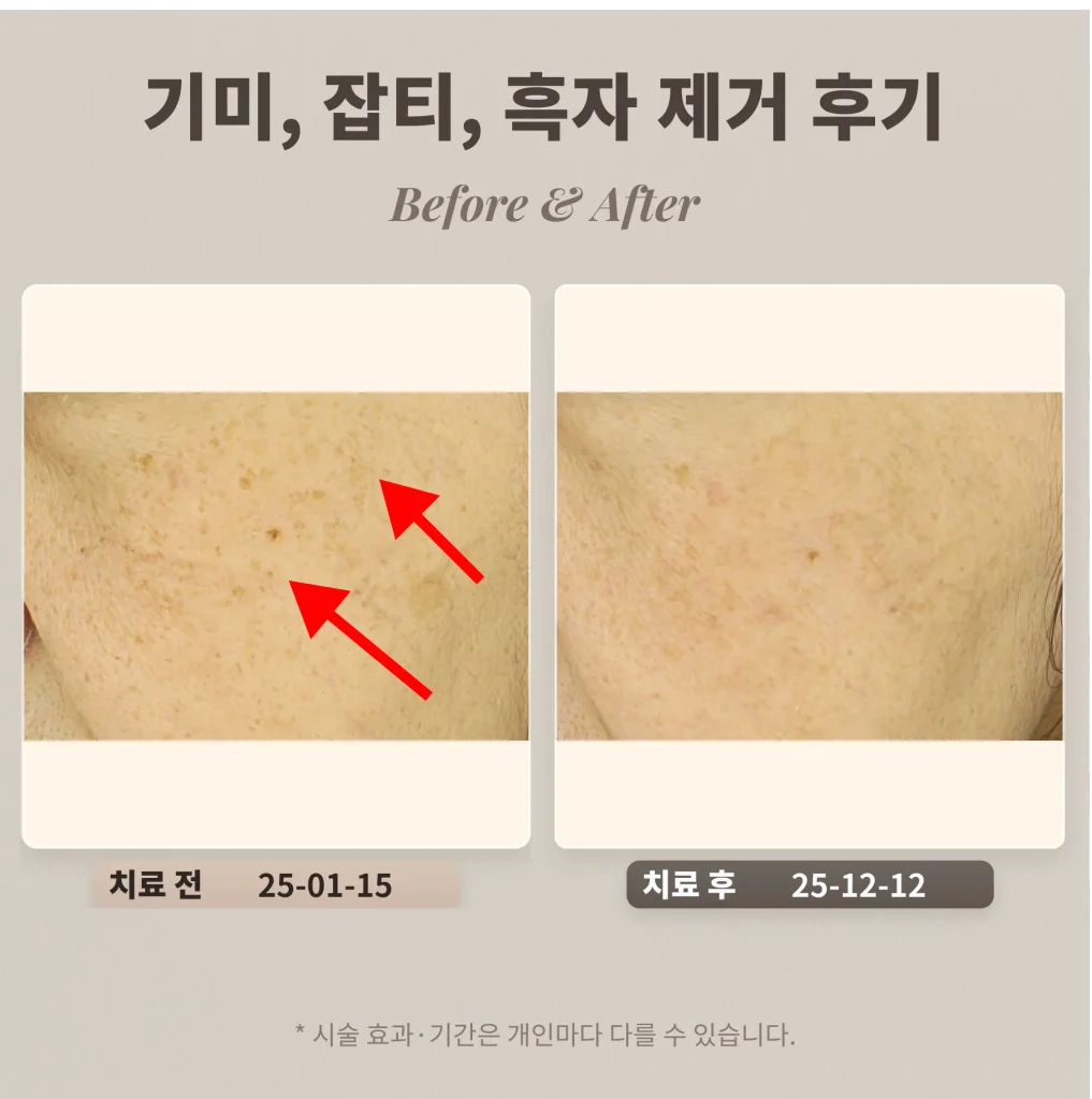 70대 기미, 잡티, 흑자 제거 후기