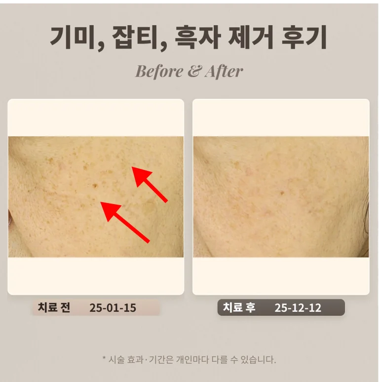 70대 기미, 잡티, 흑자 제거 후기