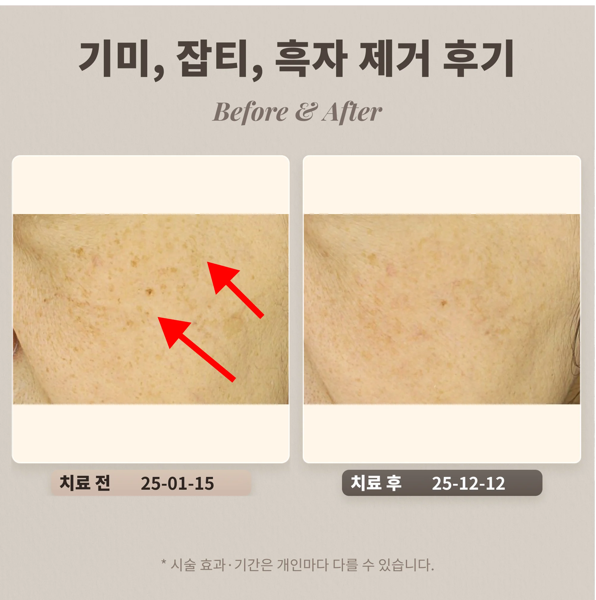 70대 기미, 잡티, 흑자 제거 후기