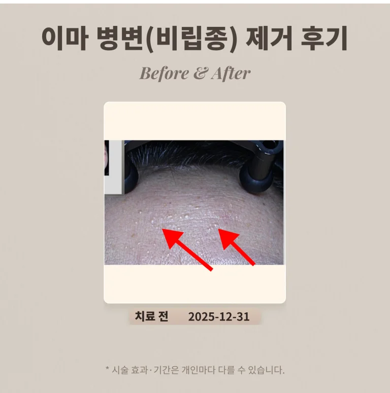 이마 오돌토돌 병변(비립종) 제거 후기_강남 피부과 전문의