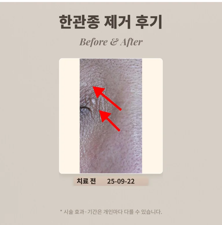 눈가 오돌토돌난 병변은 뭘까?한관종 제거 후기_강남 피부과 전문의