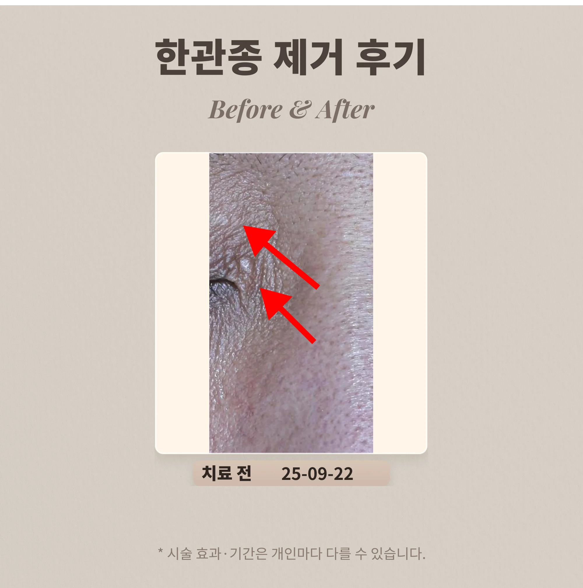 눈가 오돌토돌난 병변은 뭘까?한관종 제거 후기_강남 피부과 전문의