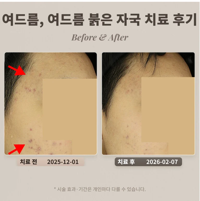 20대 관자, 볼 여드름, 여드름 붉은 자국 치료 후기