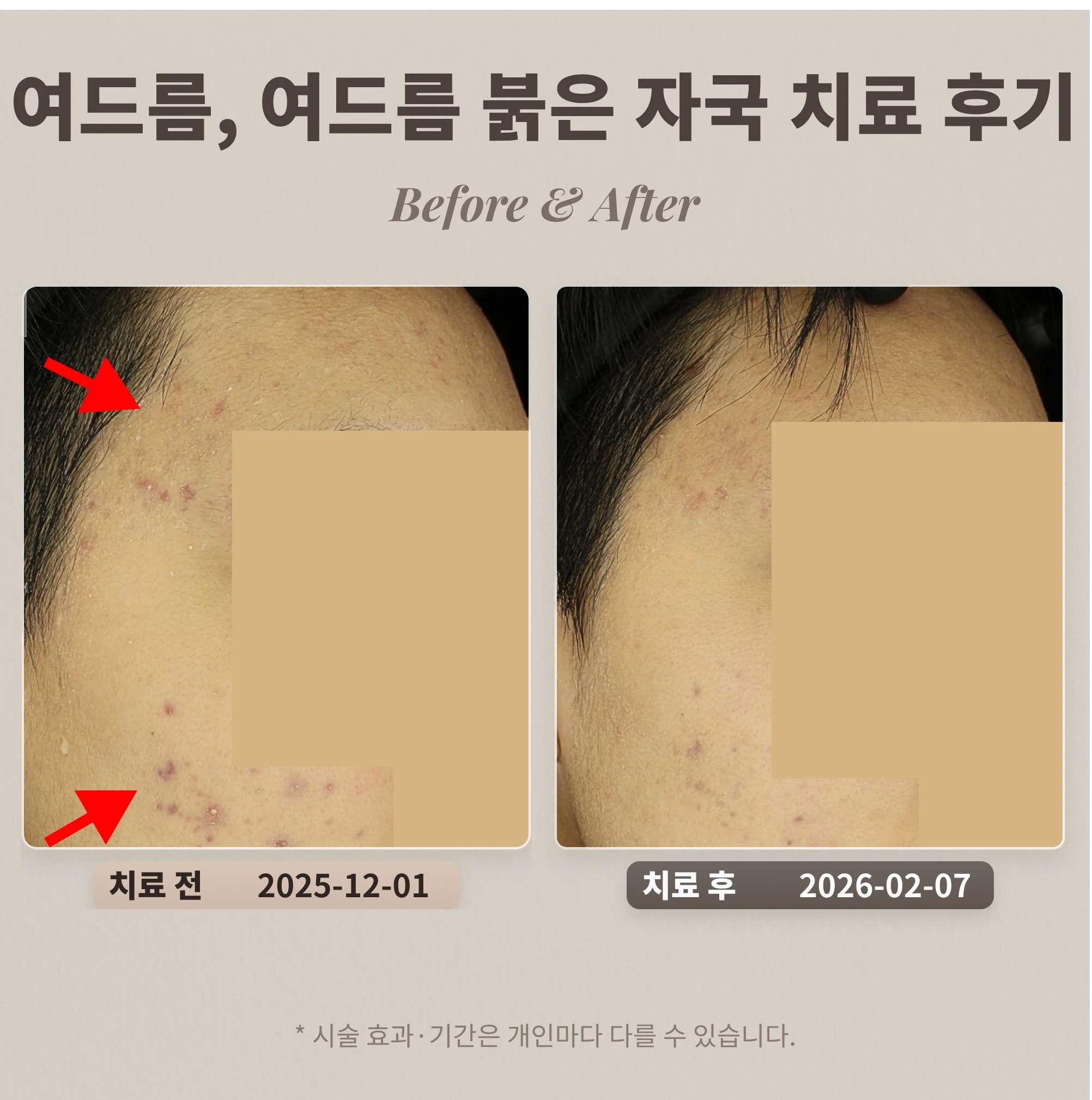 20대 관자, 볼 여드름, 여드름 붉은 자국 치료 후기