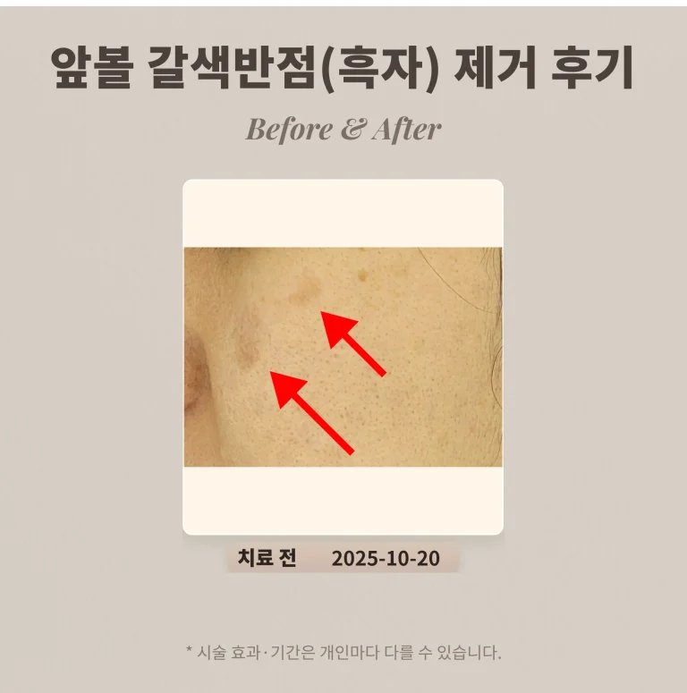 30대 앞볼 부위 갈색반점(색소침착)으로 알고 계셨던 여성의 흑자 제거 후기