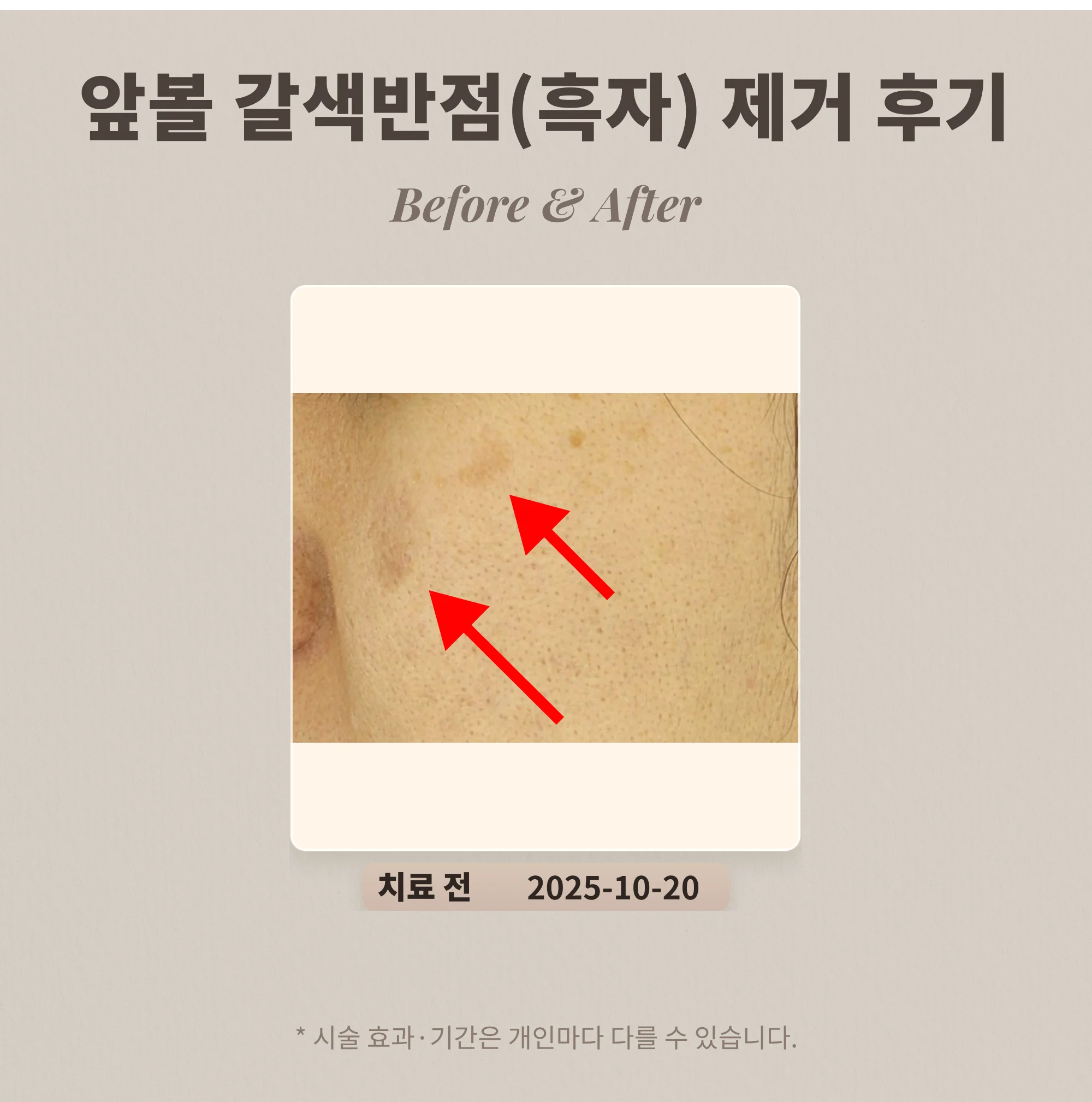 30대 여성 앞볼 부위 갈색 반점 흑자 제거 사례
