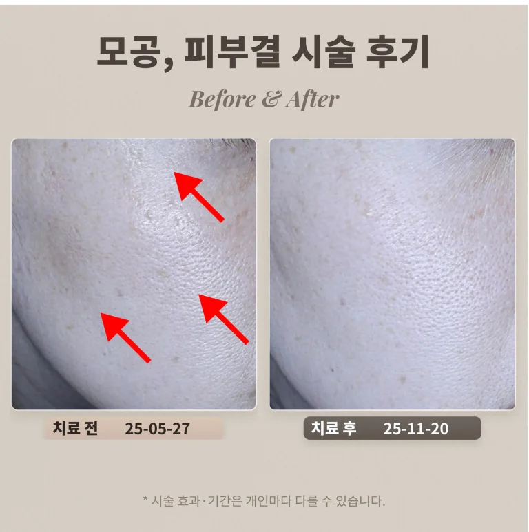 40대 모공과 피부결을 좋게 하려면, 피부과 시술 추천