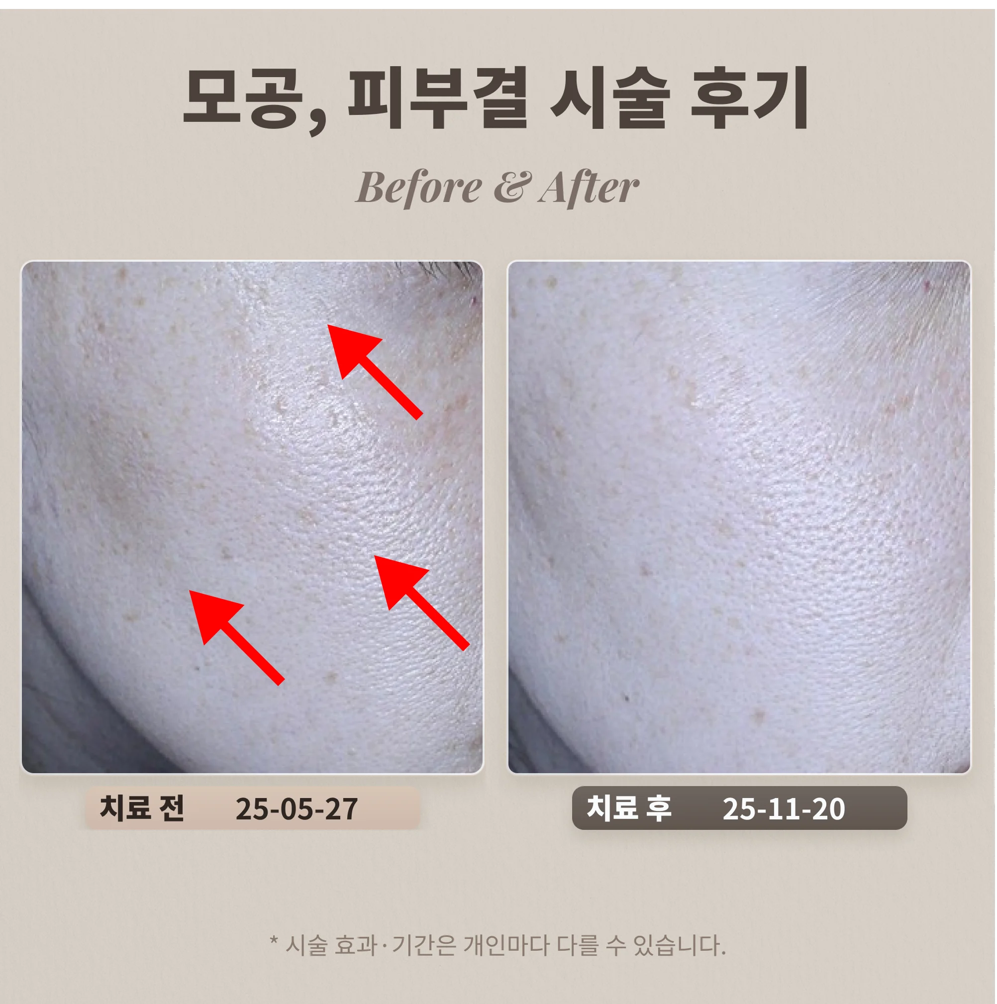 40대 모공과 피부결을 좋게 하려면, 피부과 시술 추천