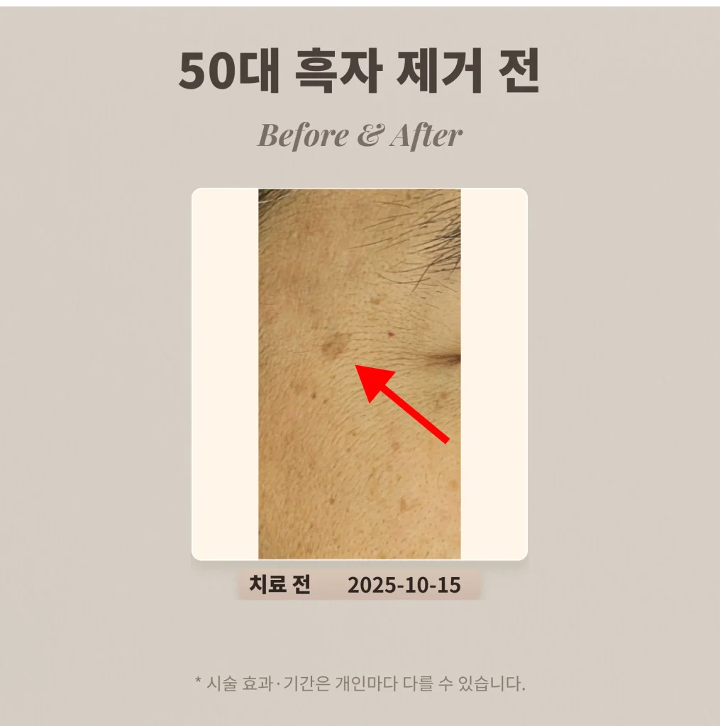 50대 흑자 제거 레이저 치료 후기 #리팟레이저
