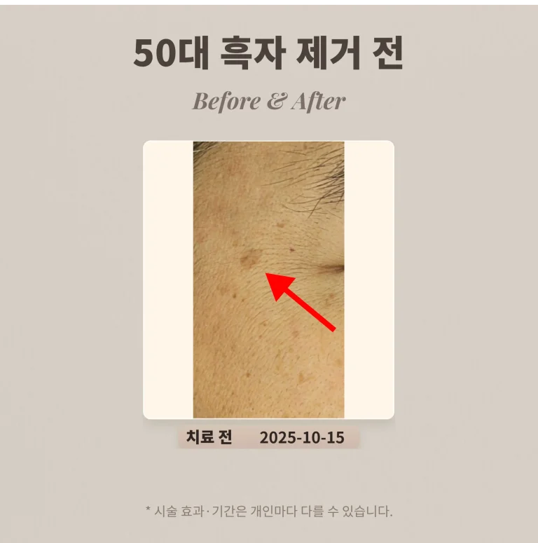 50대 흑자 제거 레이저 치료 후기 #리팟레이저