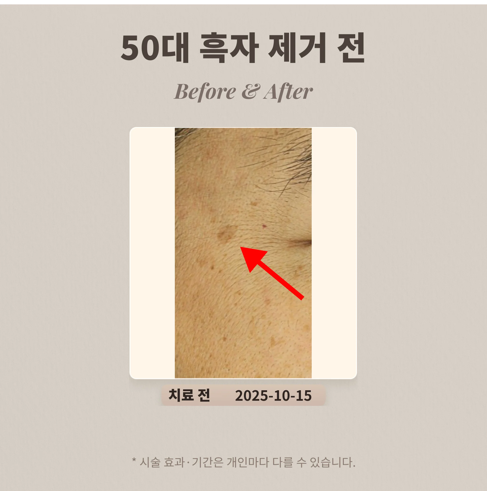 50대 흑자 제거 레이저 치료 사례