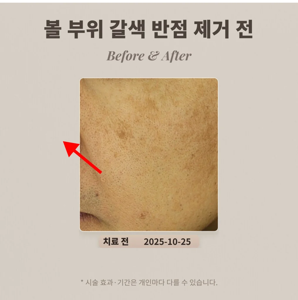 볼 부위 갈색 반점(흑자) 제거 후기 #흑자 제거 레이저 치료
