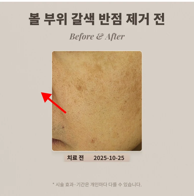 볼 부위 갈색 반점(흑자) 제거 후기 #흑자 제거 레이저 치료