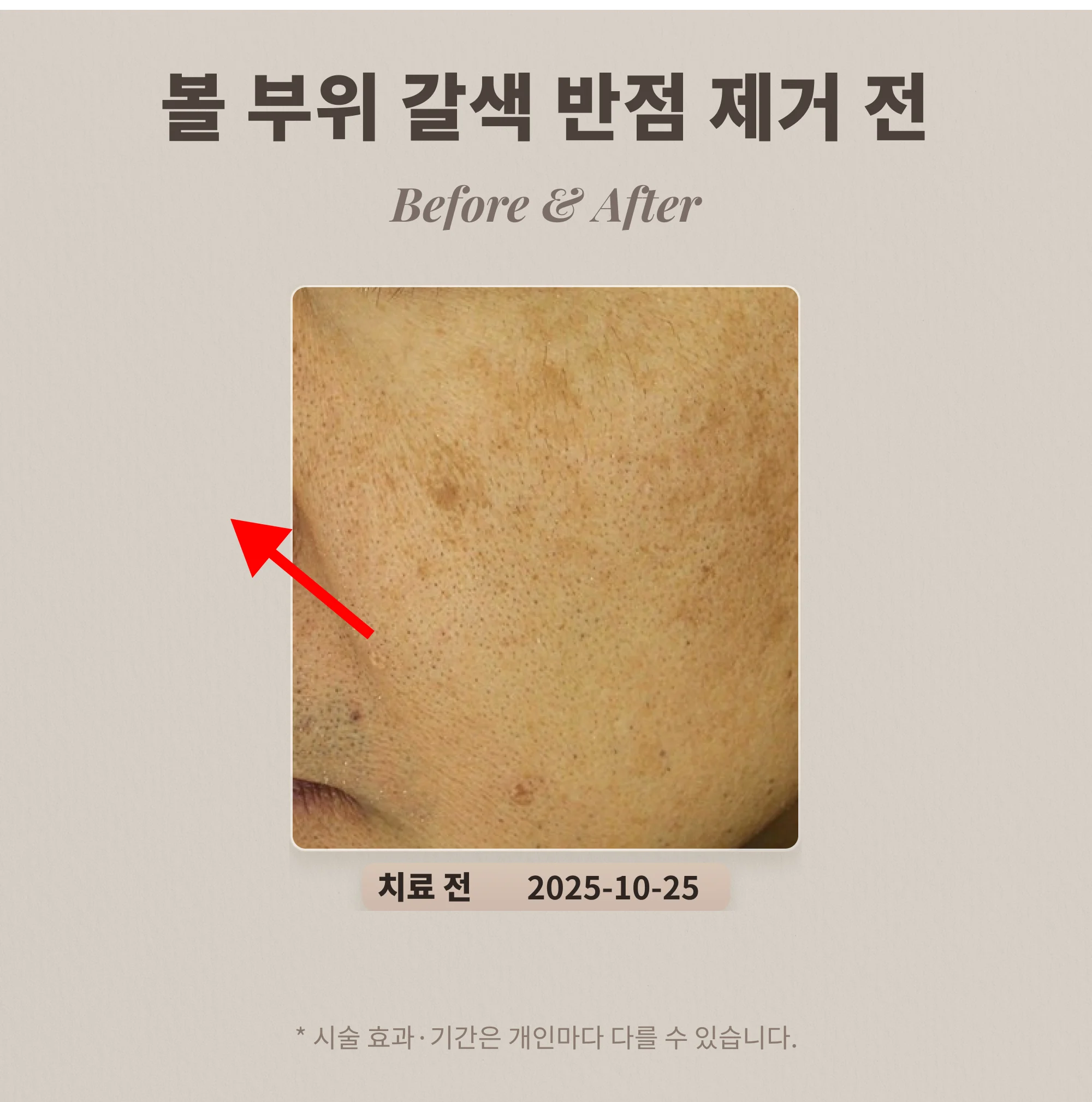 볼 부위 갈색 반점 흑자 제거 사례