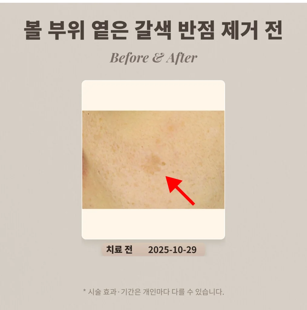 30대 여성 볼 부위 큰 옅은 갈색 반점(흑자) 제거 후기