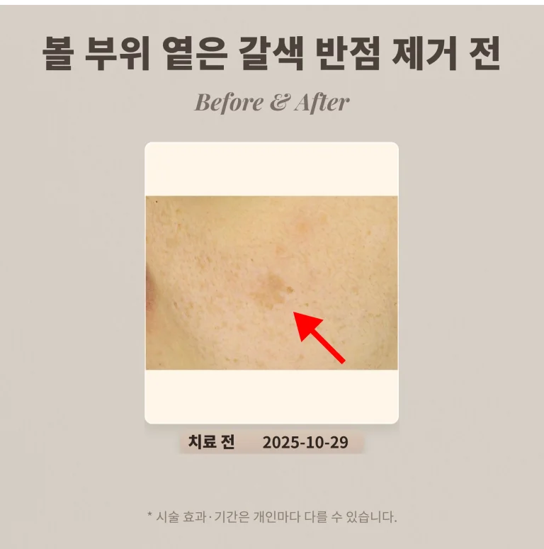 30대 여성 볼 부위 큰 옅은 갈색 반점(흑자) 제거 후기