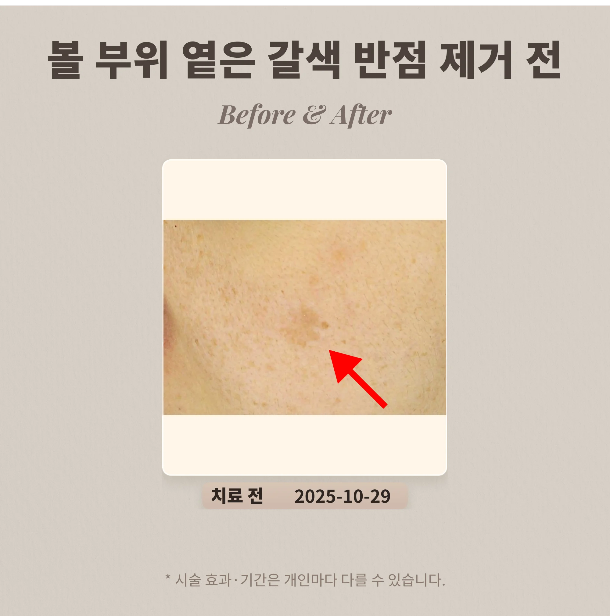 30대 여성 볼 부위 큰 옅은 갈색 반점 흑자 제거 사례