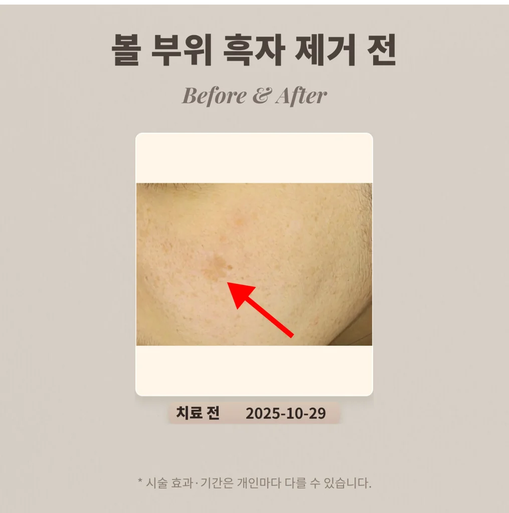 30대 볼 부위 흑자 리팟레이저로 제거 후기 #갈색반점