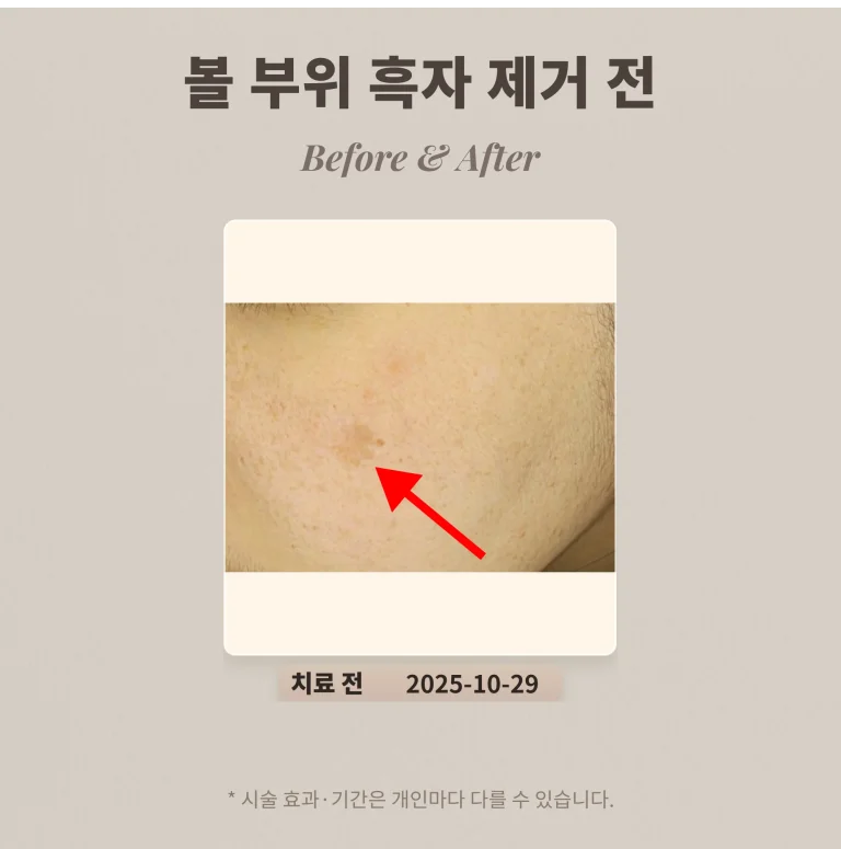 30대 볼 부위 흑자 리팟레이저로 제거 후기 #갈색반점