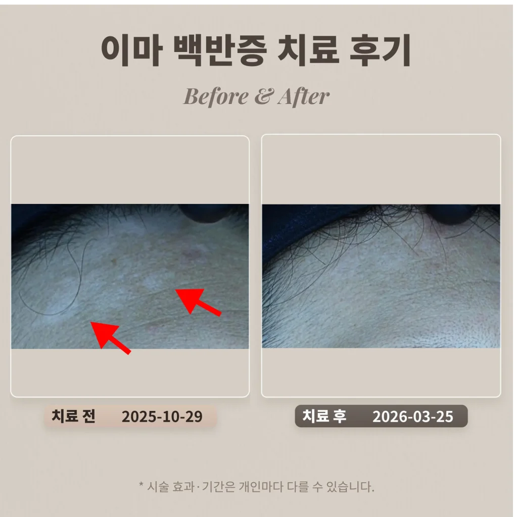 10대 여드름, 여드름 자국 치료 후기_대치동 여드름 피부과
