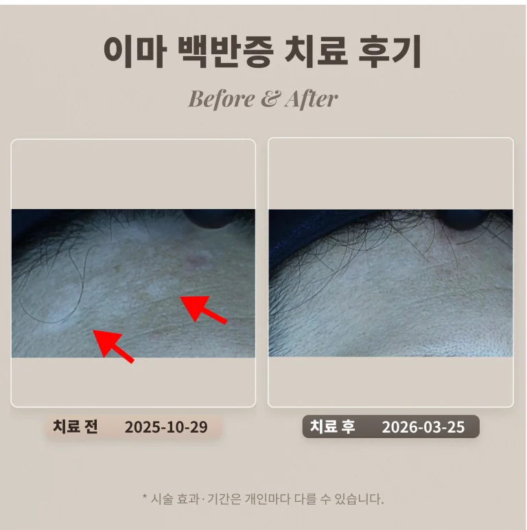 10대 여드름, 여드름 자국 치료 후기_대치동 여드름 피부과