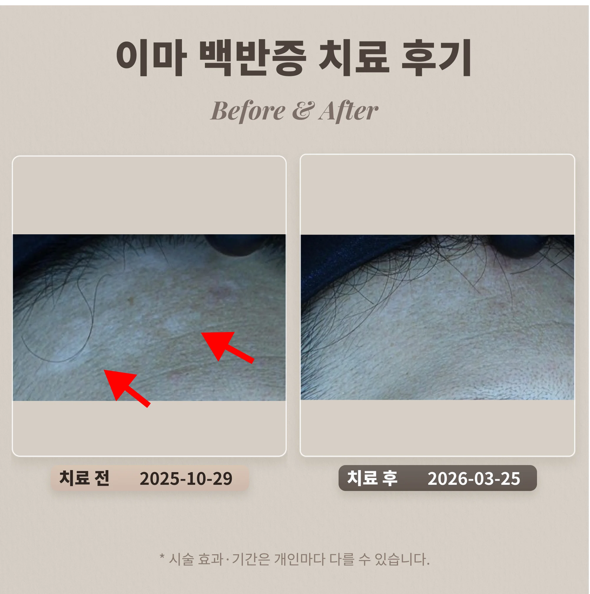 Teenage acne and acne mark treatment review - acne dermatology in Daechi-dong