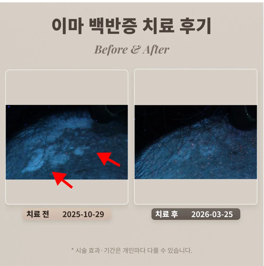 10대 학생 여드름 치료 후기_한티역 여드름 피부과
