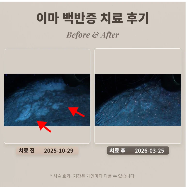 10대 학생 여드름 치료 후기_한티역 여드름 피부과