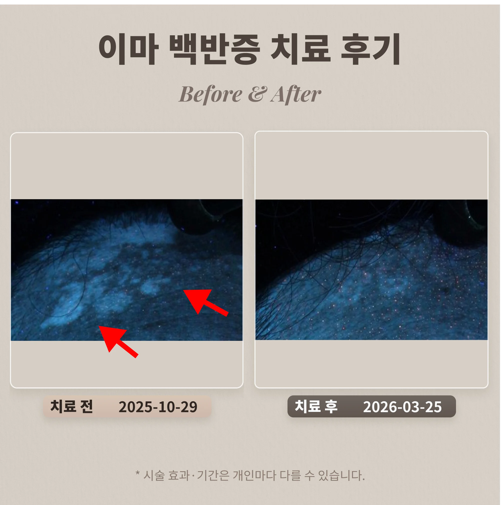 이마 백반증 치료 후기