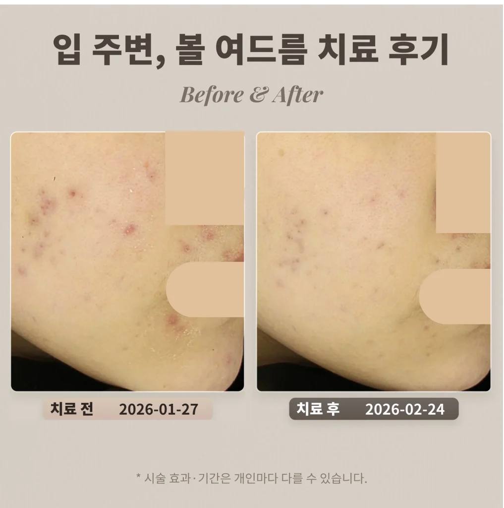 입 주변 여드름 치료 후기