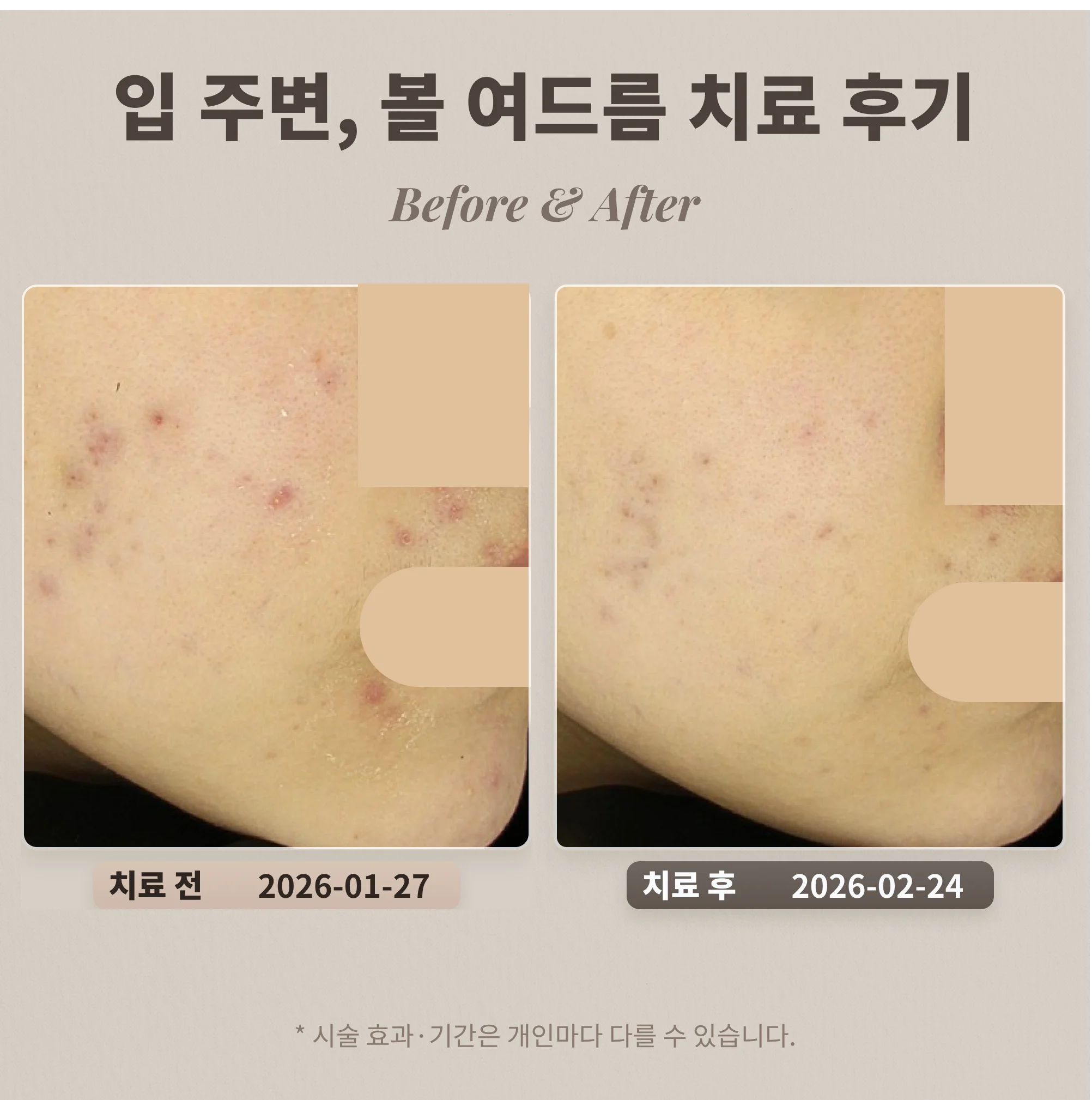 입 주변 여드름 치료 후기