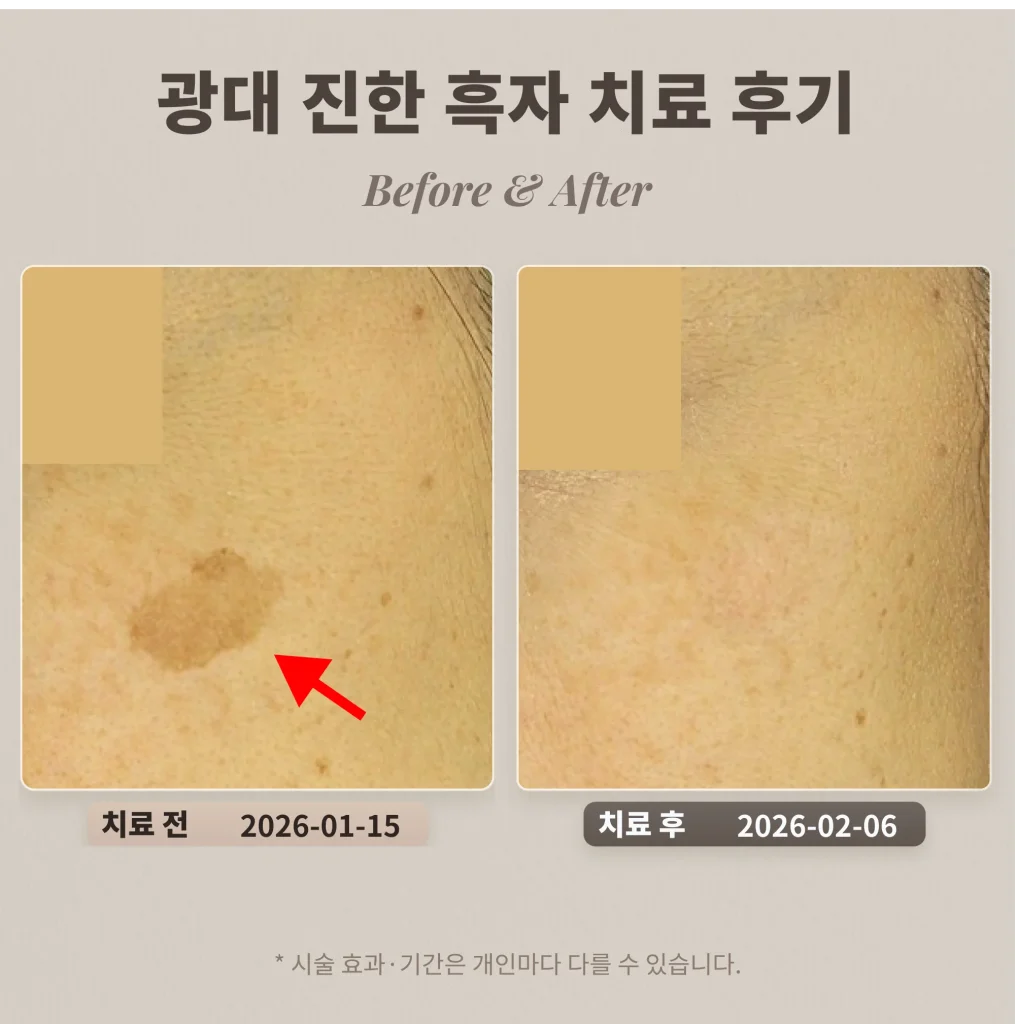 40대 여성 흑자 제거 후기_ 리팟레이저 후기